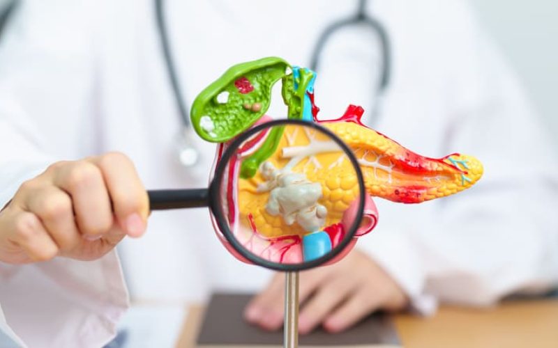 Quilomicronemia en Guatemala: impacto en la salud y cómo prevenir